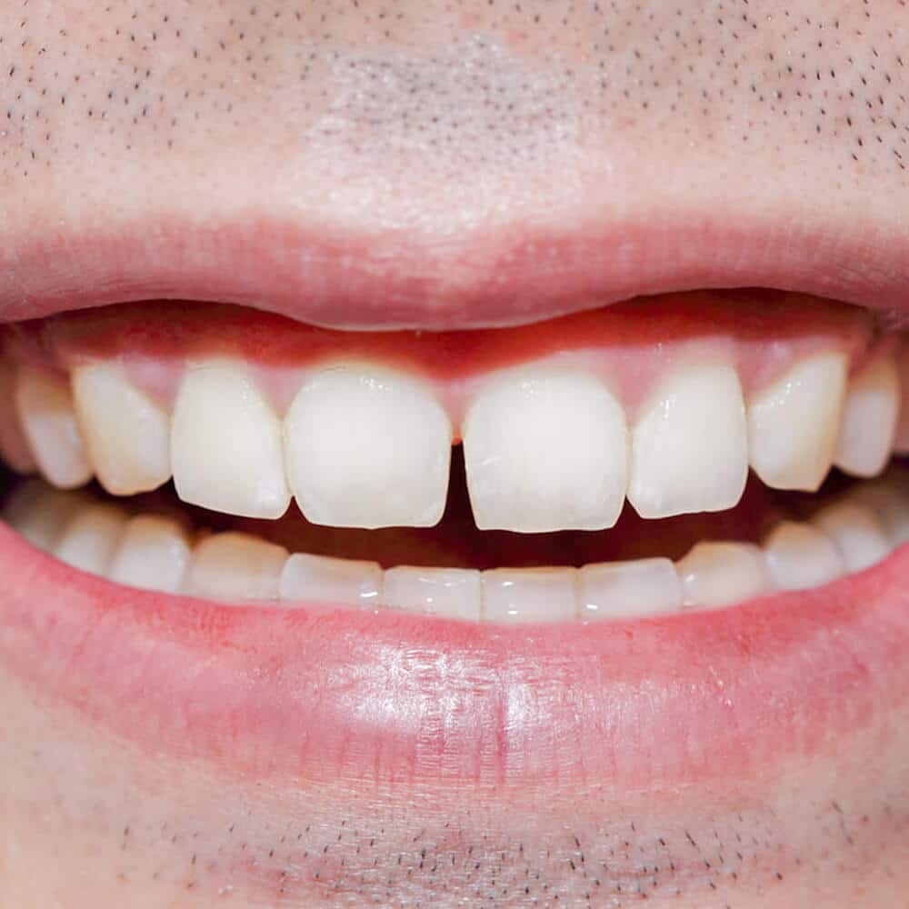 gap-spaced-teeth-compressed