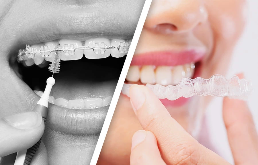 Invisalign Orthodontic - Camtu Dental