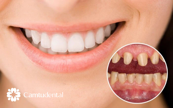 Does grinding your teeth affect dental crowns?