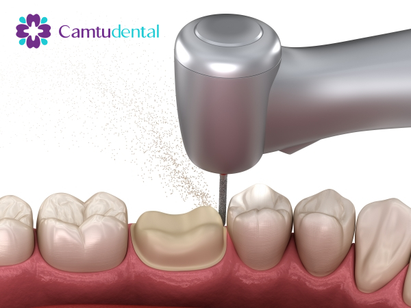 Teeth grinding is a mandatory operation when getting porcelain crowns